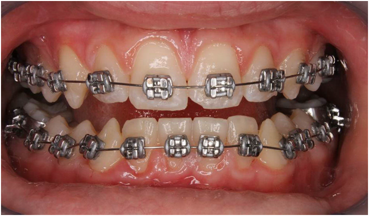 Feste Zahnspange mit Gummiligaturen 